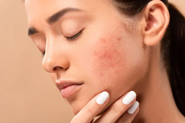 Elasty Filler for Acne Scars | 2 Case Studies